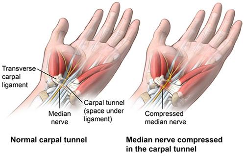 Carpal tunnel locations
